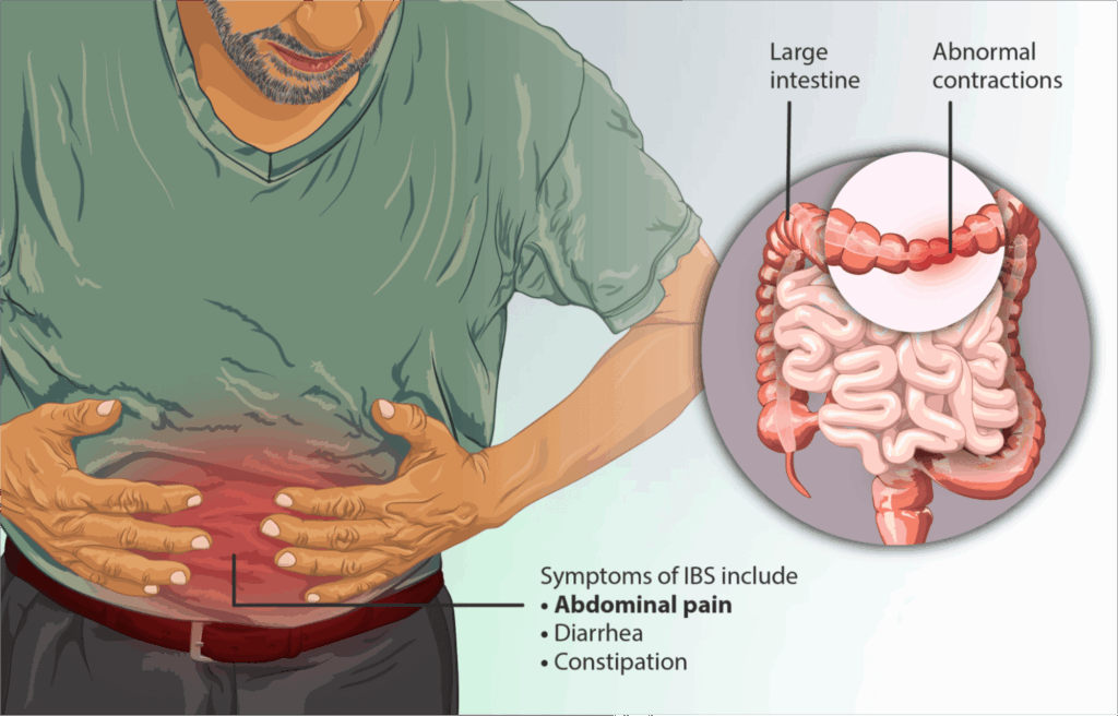 Recognizing IBS Symptoms - A Critical Step in Management